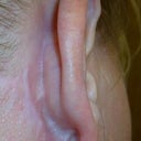 right ear scarring